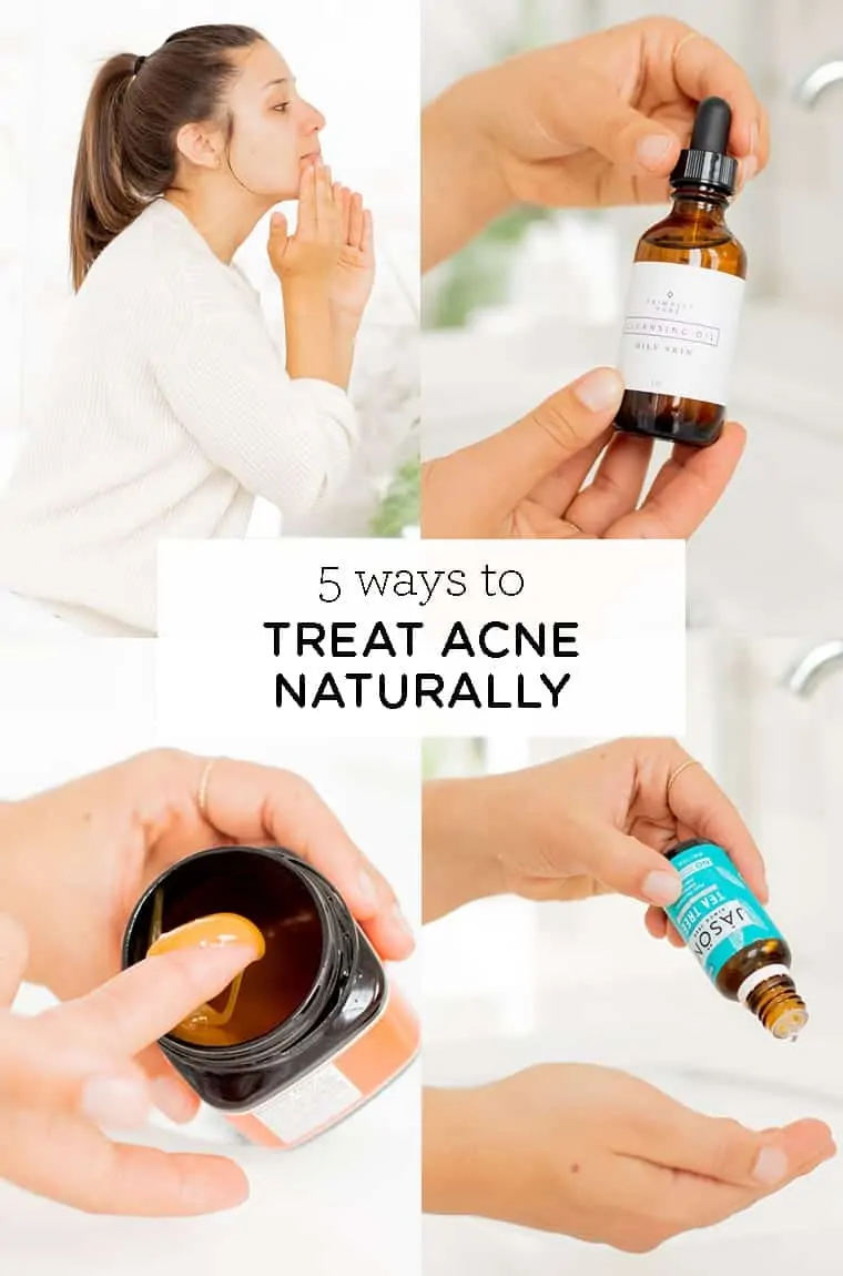 5 natural ways to treat acne